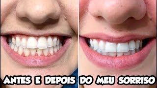 ANTES E DEPOIS DO MEU SORRISO Clareamento a laser com restauração estética [upl. by Mufinella]