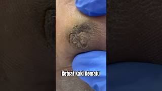 KETUAT KAKI JANGKITAN KUMAN VIRAL WARTS KERAS JADI KEMATU SAKIT  DrMan Ttdi Story [upl. by Neeleuqcaj420]