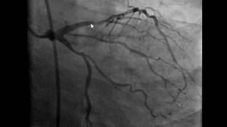 blocked artery angiogram 3 [upl. by Ettenauq]