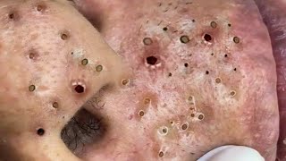 Remove Blackheads and Pimples Popping At HT Spa 36 [upl. by Adnahsat]