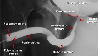 Retrograde Urethrogram  Ascending urethrography [upl. by Oatis]