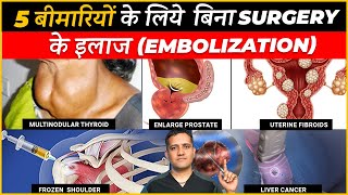 Treatment of 5 Conditions with Angiography Based Technique Embolisation  Dr Gaurav Gangwani IR [upl. by Neeneg]