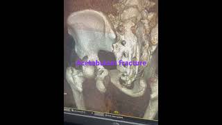 Acetabulum fracture 3D reconstruction fracture trauma [upl. by Lebar]