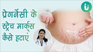 प्रेगनेंसी या डिलीवरी के बाद स्ट्रेच मार्क्स हटाने के उपाय तरीके by Dr Archana [upl. by Annodahs133]