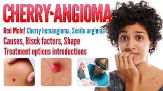 Cherry angioma causes Shapes and treatment options  Red Mole Cherry Hemangioma  Mole Removal [upl. by Corine316]