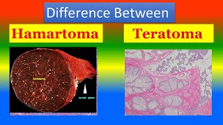 Difference between Hamartoma and Teratoma [upl. by Fisken646]