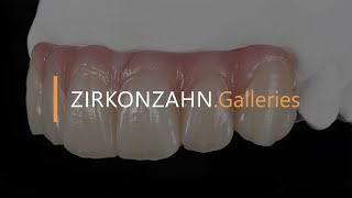 Prettau® zirconia – Screwretained sixunit anterior restoration  ZirkonzahnGalleries [upl. by Rorrys]