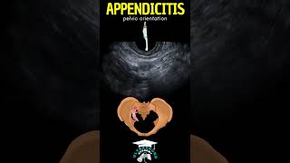 Pelvic Appendicitis on Ultrasound A 50Second Ultrasound Case Study appendicitis ultrasound [upl. by Ezarras909]