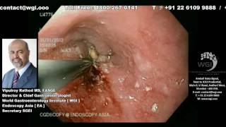 Endoscopic procedure of Esophageal Metal Stenting [upl. by Hickey]