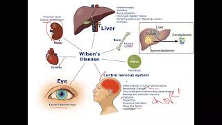 pediatric Hepatology Wilsons Disease [upl. by Shiri562]