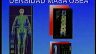 OSTEOPOROSIS Y ALIMENTACIÓN [upl. by Enilarac]