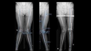 Surgical Realignment Knock Knee Correction [upl. by Hsiwhem]