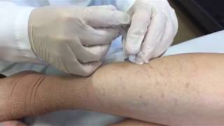 Varicose Vein Treatment  George Anton MD [upl. by Roinuj714]