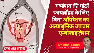 Uterine Artery Embolization UAE Explained amp Live Surgery by Dr Amol Lahoti [upl. by Anavrin]