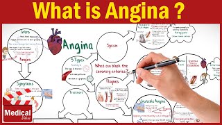 Pharmacology CVS 16 What is Angina Pectoris  Types of Angina Symptoms Causes and Treatment [upl. by Kelsey]