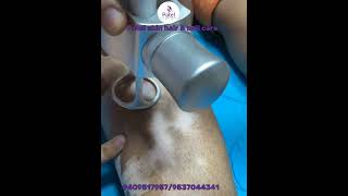 Vitiligo surgeryvitiligo treatmentmelanosite transfer treatmentskin caredermatologist [upl. by Sidoon942]