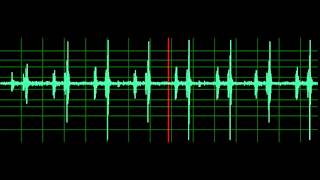 Pulmonary Associated Heart Sounds PAH Split S2 [upl. by Hobard]