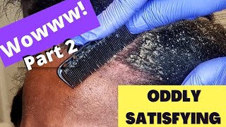 Oddly Satisfying Insane Dandruff Scratching Flakes Scalp Condition Removal After Braids Pt 2 [upl. by Mariele517]