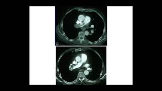 EMBOLIE PULMONAIRE Pr M METAHRI [upl. by Olathe]