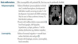 USMLE STEP 1  Neurology  Neural defects Brain malformation [upl. by Buckingham]