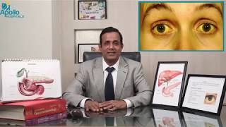 Jaundice Pilia in Hindi by Dr Shravan Bohra Liver Specialist Apollo Hospitals Ahmedabad [upl. by Frost359]