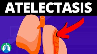 Atelectasis Medical Definition  Quick Explainer Video [upl. by Odnanreh480]