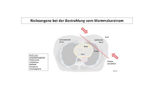 Risikoorgane bei der Bestrahlung vom Mammakarzinom  Strahlentherapie Prof Hilke Vorwerk [upl. by Egwan]