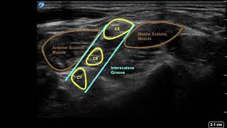 Ultrasound guided interscalene and supraclavicular brachial plexus block [upl. by Eiralih184]