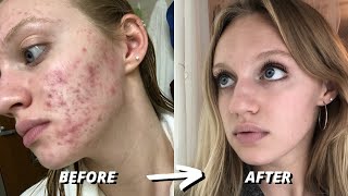 HOW I CLEARED 7 YEARS OF SEVERE ACNE  ACCUTANE JOURNEY [upl. by Onoitna602]