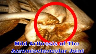 Mild Arthrosis Of The Acromioclavicular Joint [upl. by Aipotu]