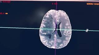 CT Brain perfusion on GE workstation full detailed explanation [upl. by Kopaz]