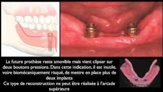 Prothèse amovible et implants dentairesMandibular overdentures [upl. by Alyac763]