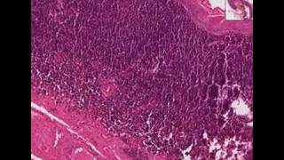 Histopathology Neck Branchial cyst lymphoepithelial cyst [upl. by Salakcin]