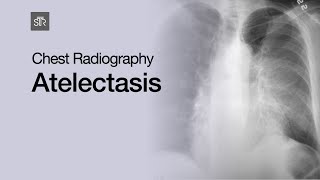 Chest Radiography Atelectasis [upl. by Novyad967]