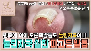 말려 들어가면서 눌린자국이 생겨버린 오른쪽발톱 ingrown toenail  ingrowing nail  Fresh Foot 풋풋한리쌤 성수점  평내호평점 [upl. by Akirret]