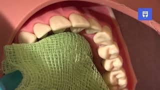 Management of a laterally luxated permanent tooth [upl. by Moe]