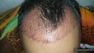 Redness after Hair Transplant  Shedding phase [upl. by Yesac]