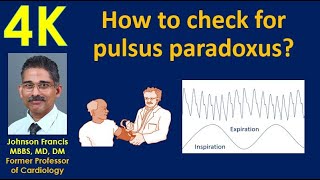 How to check for pulsus paradoxus [upl. by Nena]