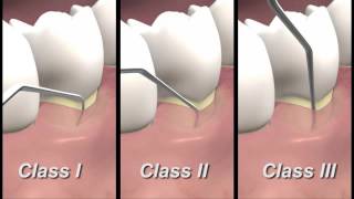 Periodontal Examination Burnaby Vancouver Periodontist IMPrESS Perio Dr Mehdi Noroozi [upl. by Africah282]