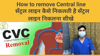 How to remove Central line central line nikalna sikhe simple procedure Central line removal [upl. by Eahs831]