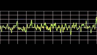 Cluster Headaches  Rife Frequencies [upl. by Durant715]