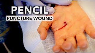 HE STABBED HIS HAND WITH A PENCIL puncture wound  Dr Paul [upl. by Hcab]