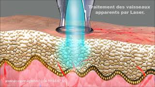 Traitement de la couperose par laser vasculaire à montpellier Saint Gély du Fesc [upl. by Balduin668]