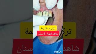 ازالة تركيبات قديمة من البورسلان شاهد قبل وبعد dentist stitch اكسبلور stitchlover ترند [upl. by Gnanmos]