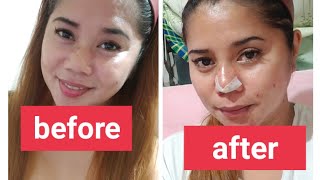 nag pa Retoke ako ng nose by Hiko Thread nose lift enhance your beauty thank you Pinkwork [upl. by Nandor680]