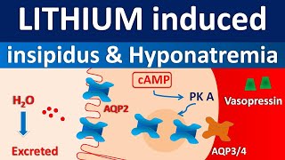 Lithium induced diabetes insipidus and hyponatremia [upl. by Eilhsa672]