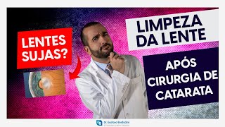 Capsulotomia com YAG laser limpeza da lente após cirurgia de catarata  Dr Gustavo Bonfadini [upl. by Sayles]