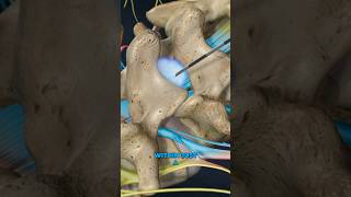 Lumbar Epidural Steroid Injection 3D Animation [upl. by Assirralc]