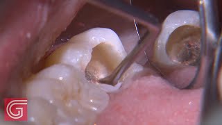 HOW TO Clean Up Severe Occlusal Decay on TOOTH 31 1 of 2 [upl. by Allets]