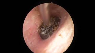 Easy earwax removal简单的耳屎清理20230827 [upl. by Margaretta]